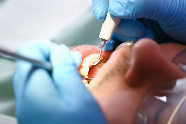 Emergency Dental Filling Replacement in WV